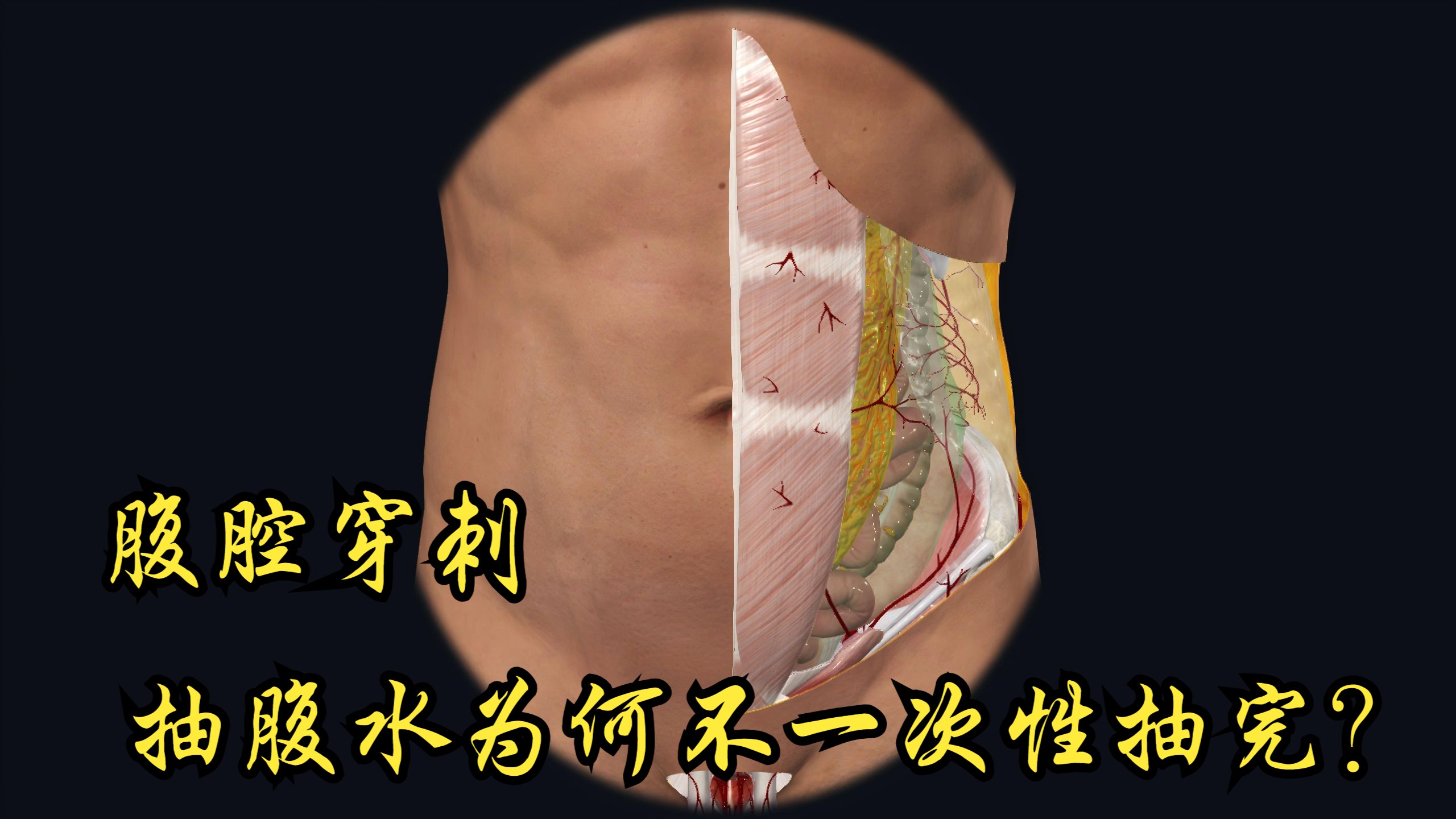 腹腔穿刺抽腹水，为何不一次性抽完？