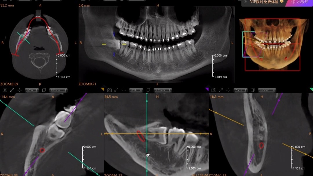 48水平阻生智齿拔除视频+解说