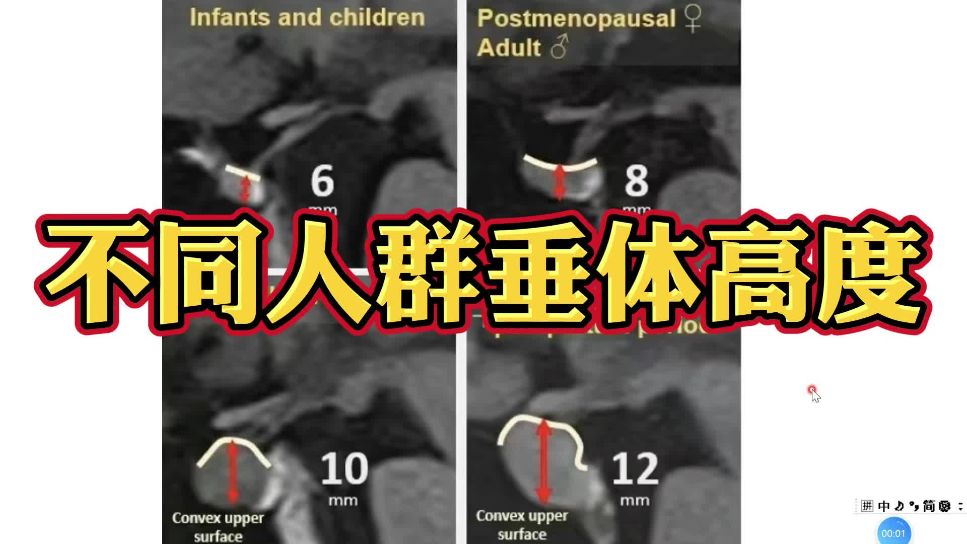 不同人群正常垂体高度影像分享，初学者一定要看看！