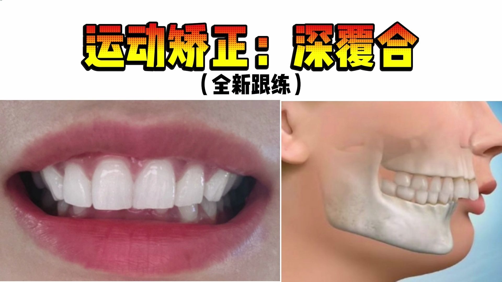 运动矫正深咬合（全新跟练）