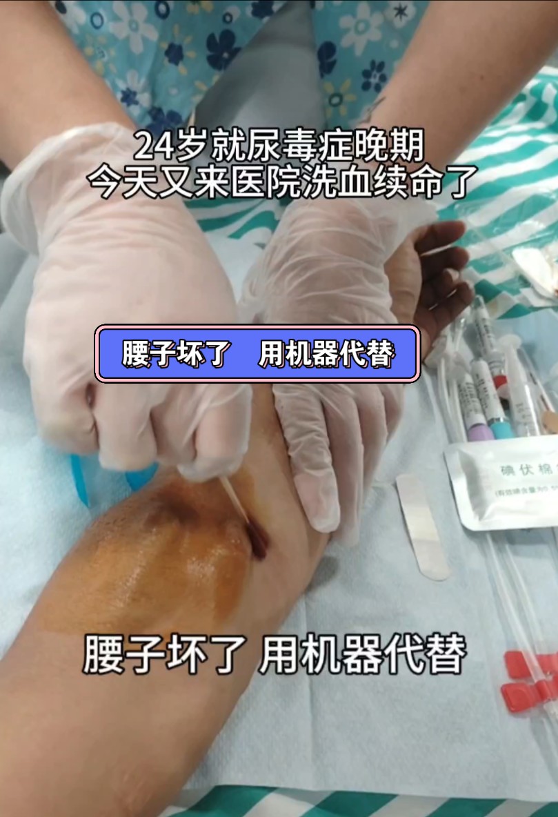尿毒症晚期，治疗一次扎两针，一个礼拜扎六针，一个月扎24针，一年扎
