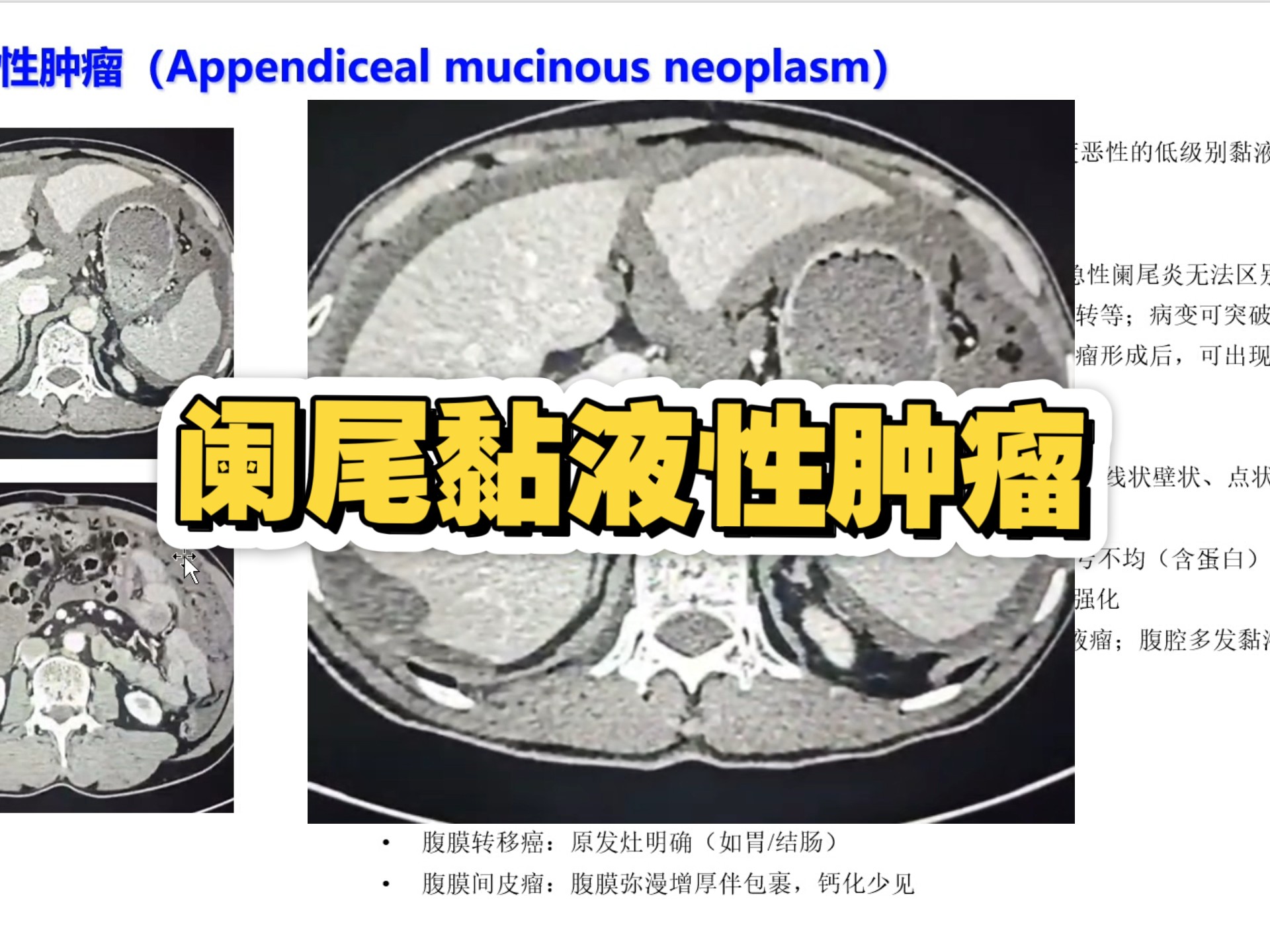 除了急性阑尾炎，你了解阑尾黏液性肿瘤（appendiceal mucinous n