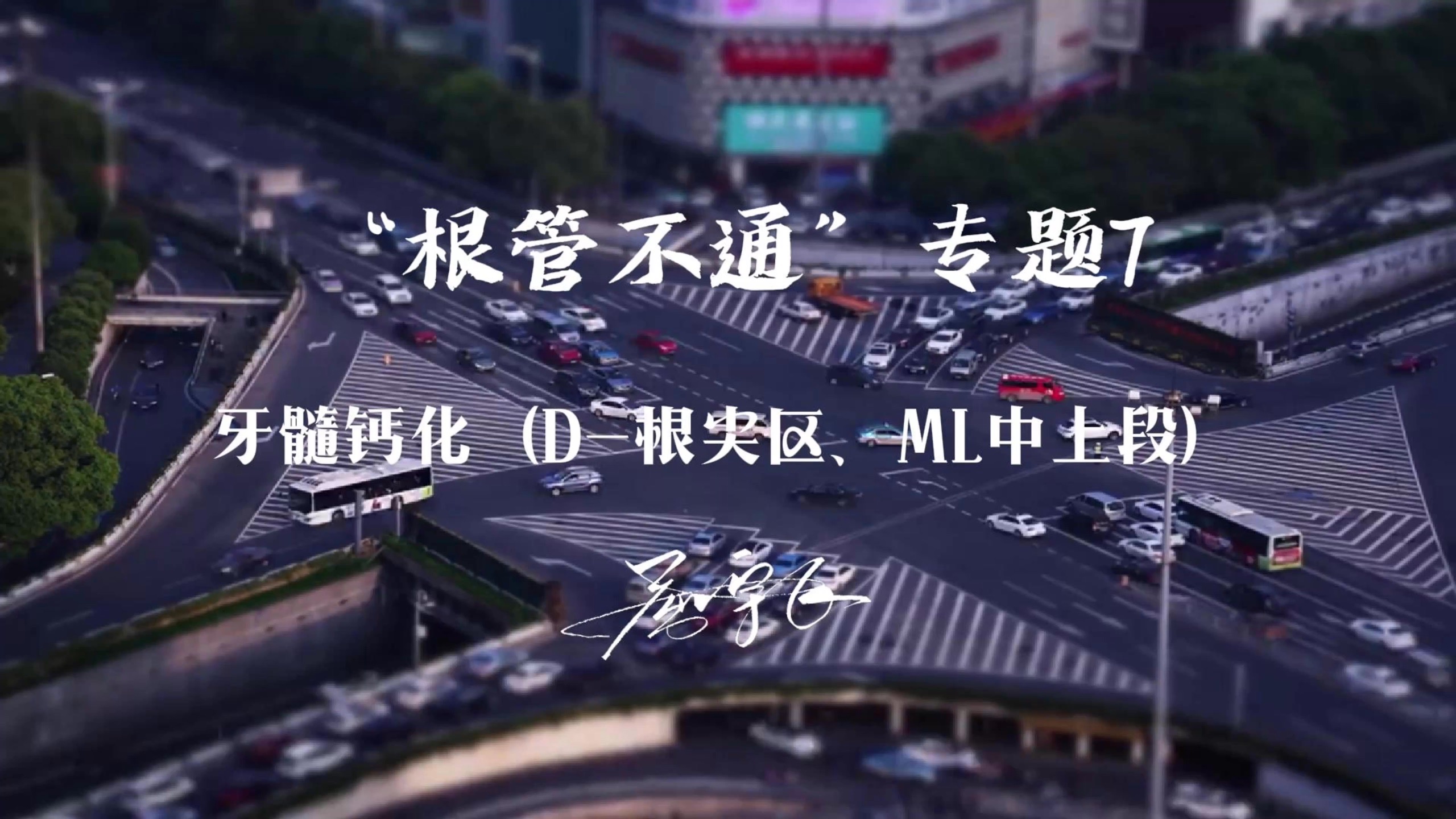 “根管不通”专题7牙髓钙化（D-根尖区、ML中上段）