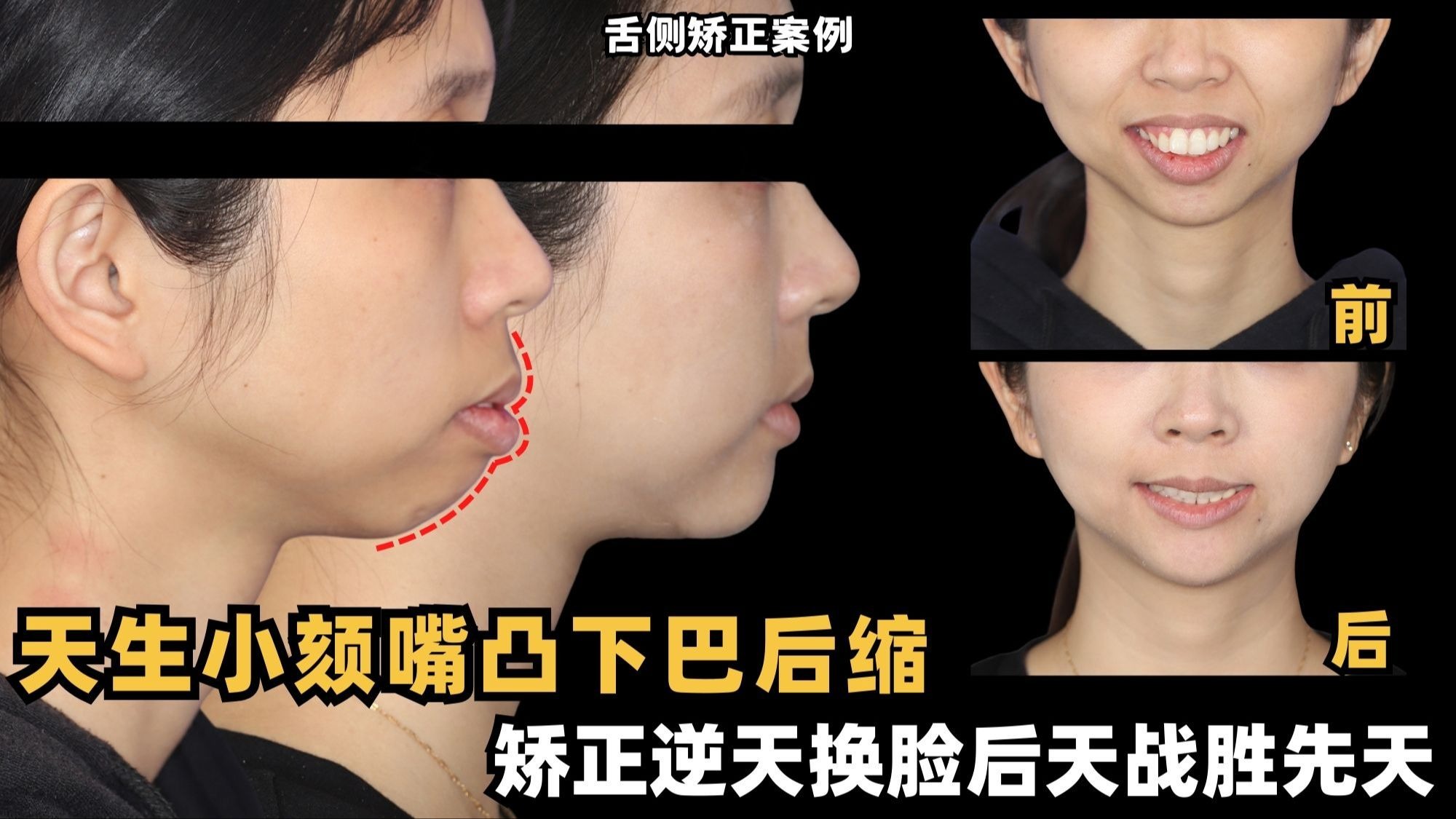 【正畸博士】天生小颏嘴凸下巴后缩，不做手术只矫正，逆天换脸后