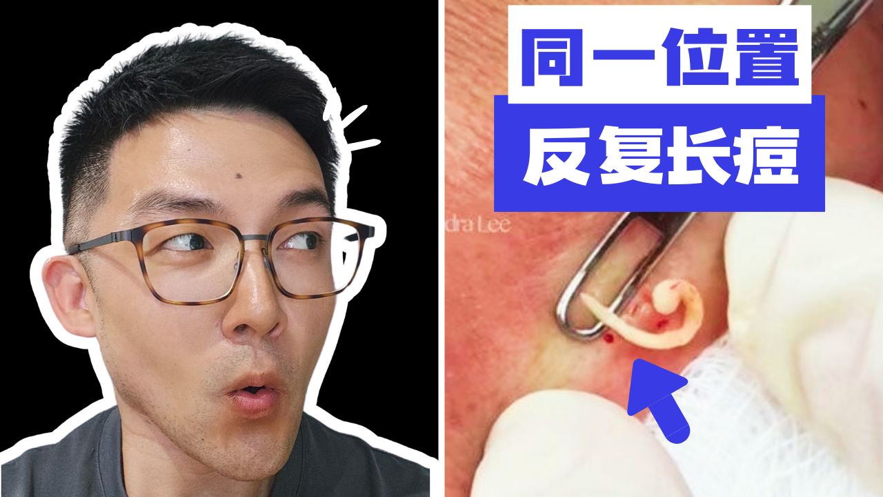 春天=烂脸？反复爆痘，凶手就在枕边！