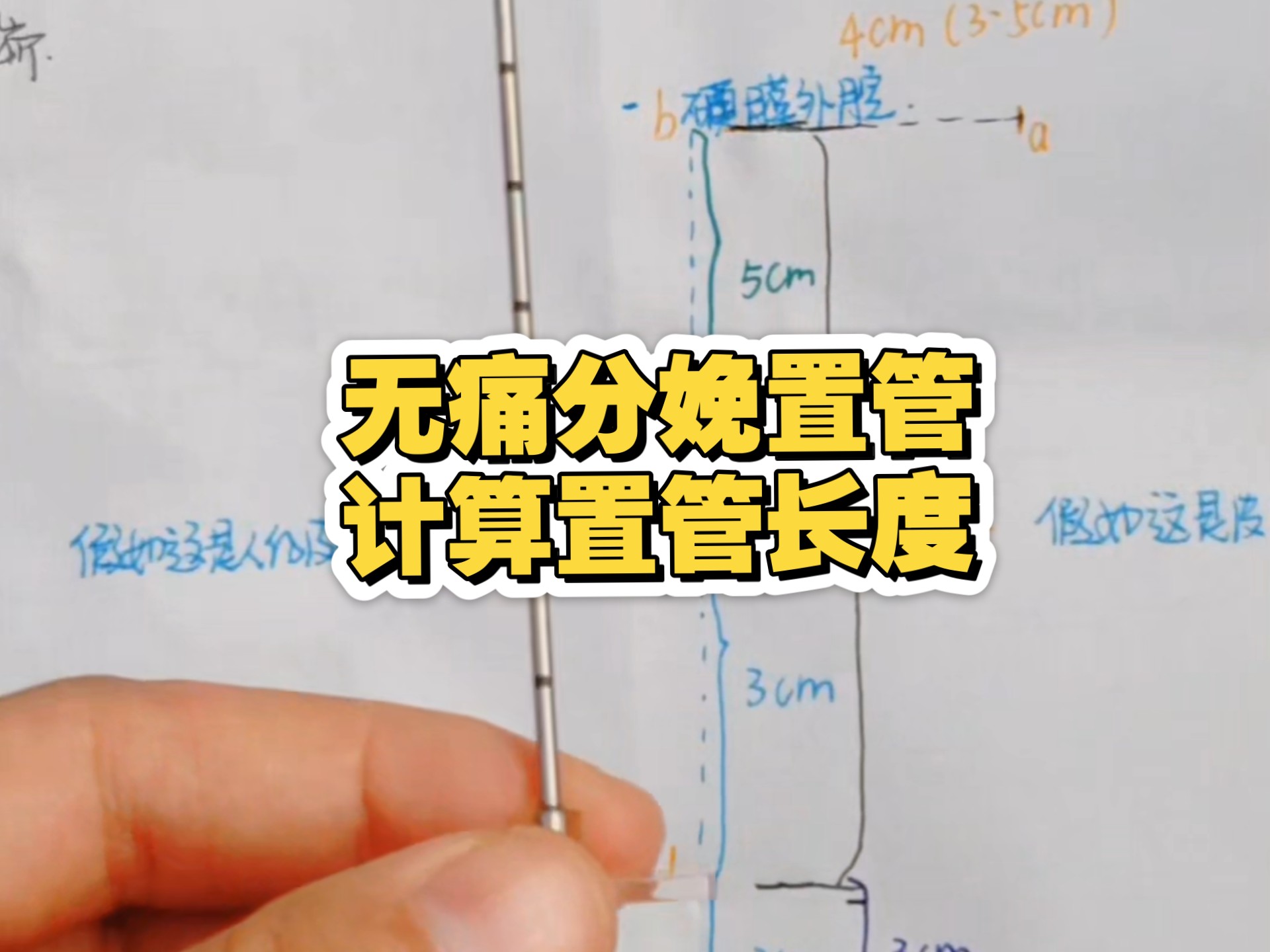 临床麻醉技能｜无痛分娩置管长度计算