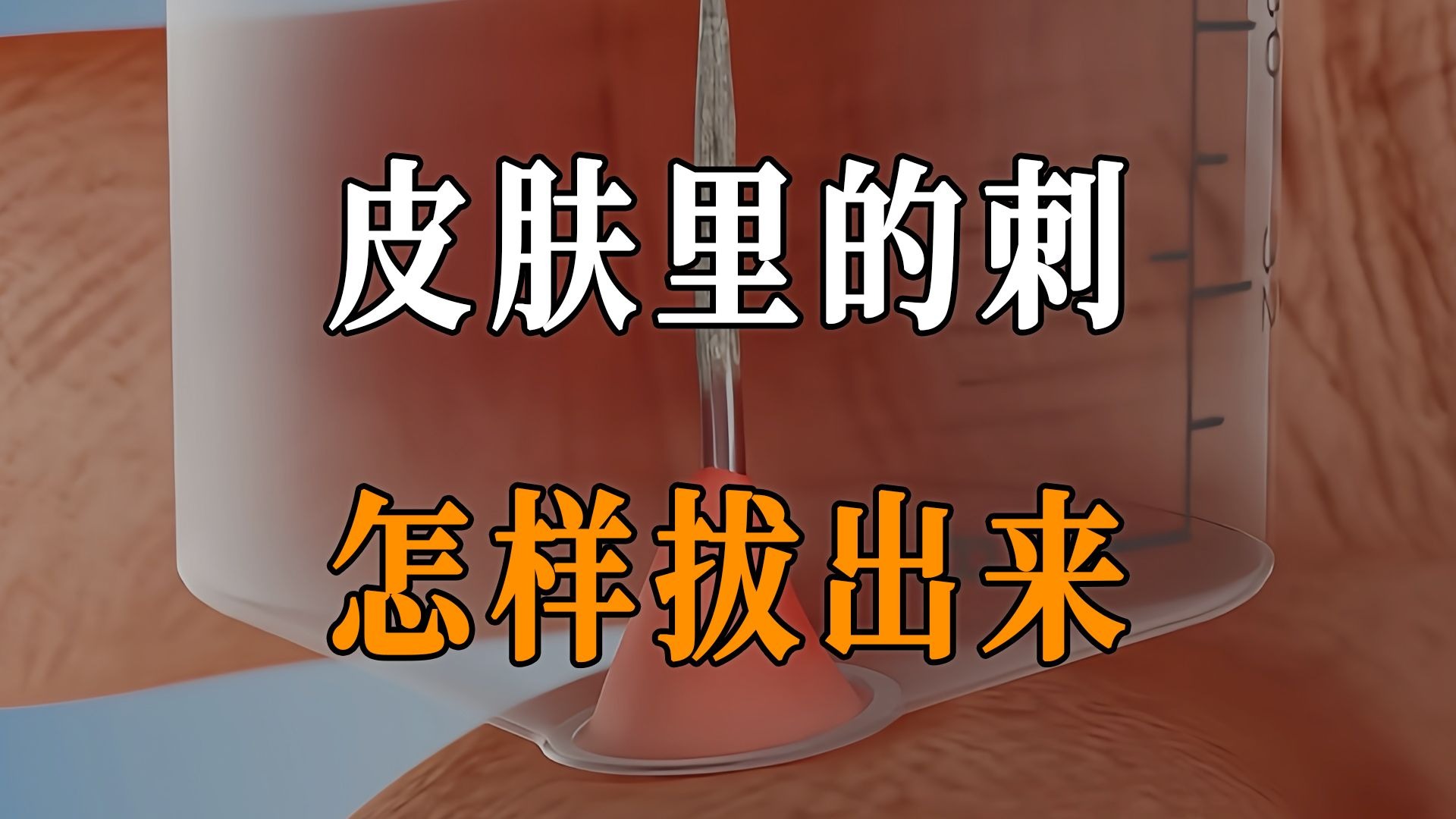 皮肤里扎的刺，应该怎样拔出来？