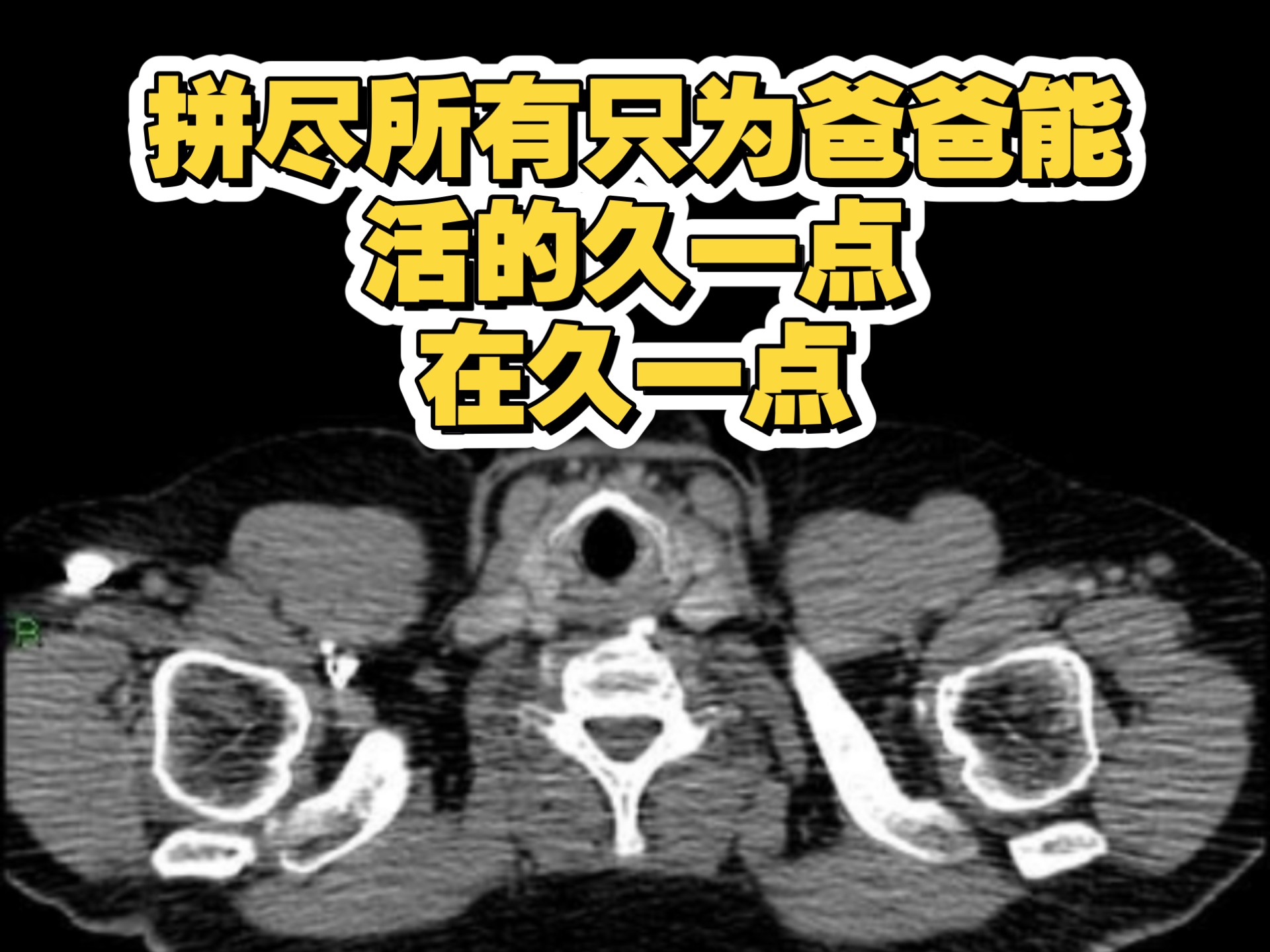爸爸肺癌晚期费用告急，拼尽所有泣血求助，每一次转发都是生命的