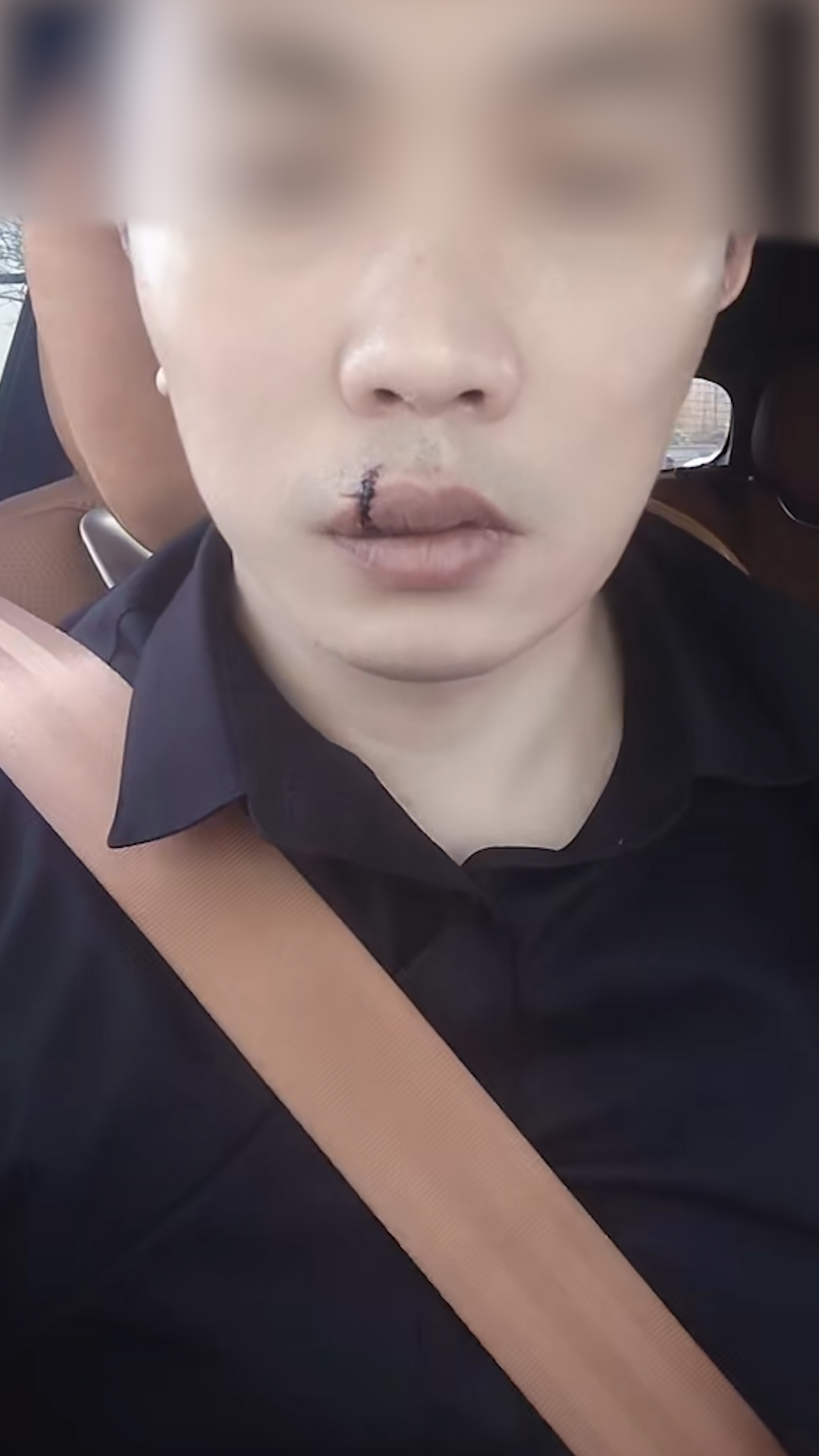 小鹏汽车回应充电枪砸伤车主缝8针：充电线缆没有正确放置到位