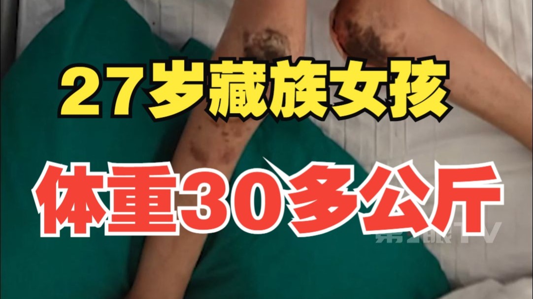 藏族女孩四肢关节全部融合，卧床十多年