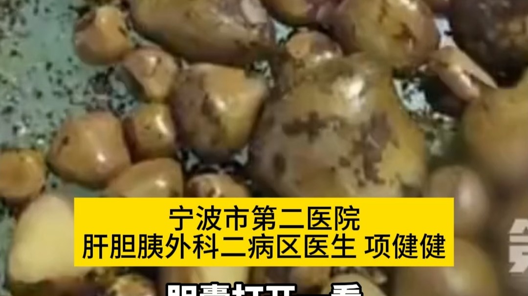 26岁女孩不吃早饭胆囊长满碎石。