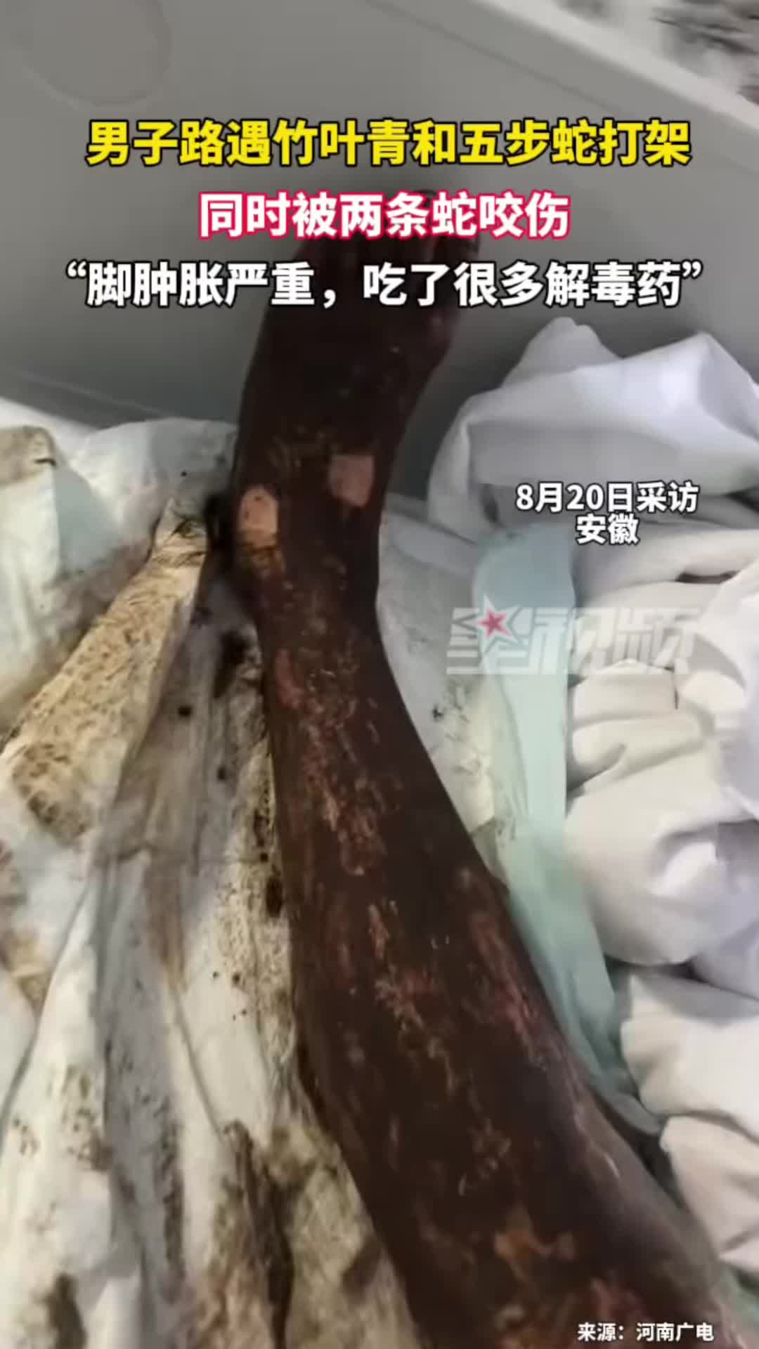 男子走路时遇竹叶青和五步蛇打架，同时被两条蛇咬伤，腿肿胀严重