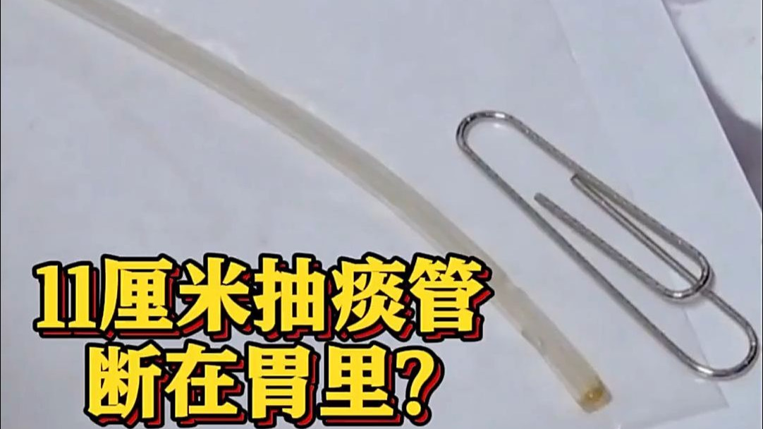 胃里藏11厘米抽痰管 癌症老人住院2周查不出原因