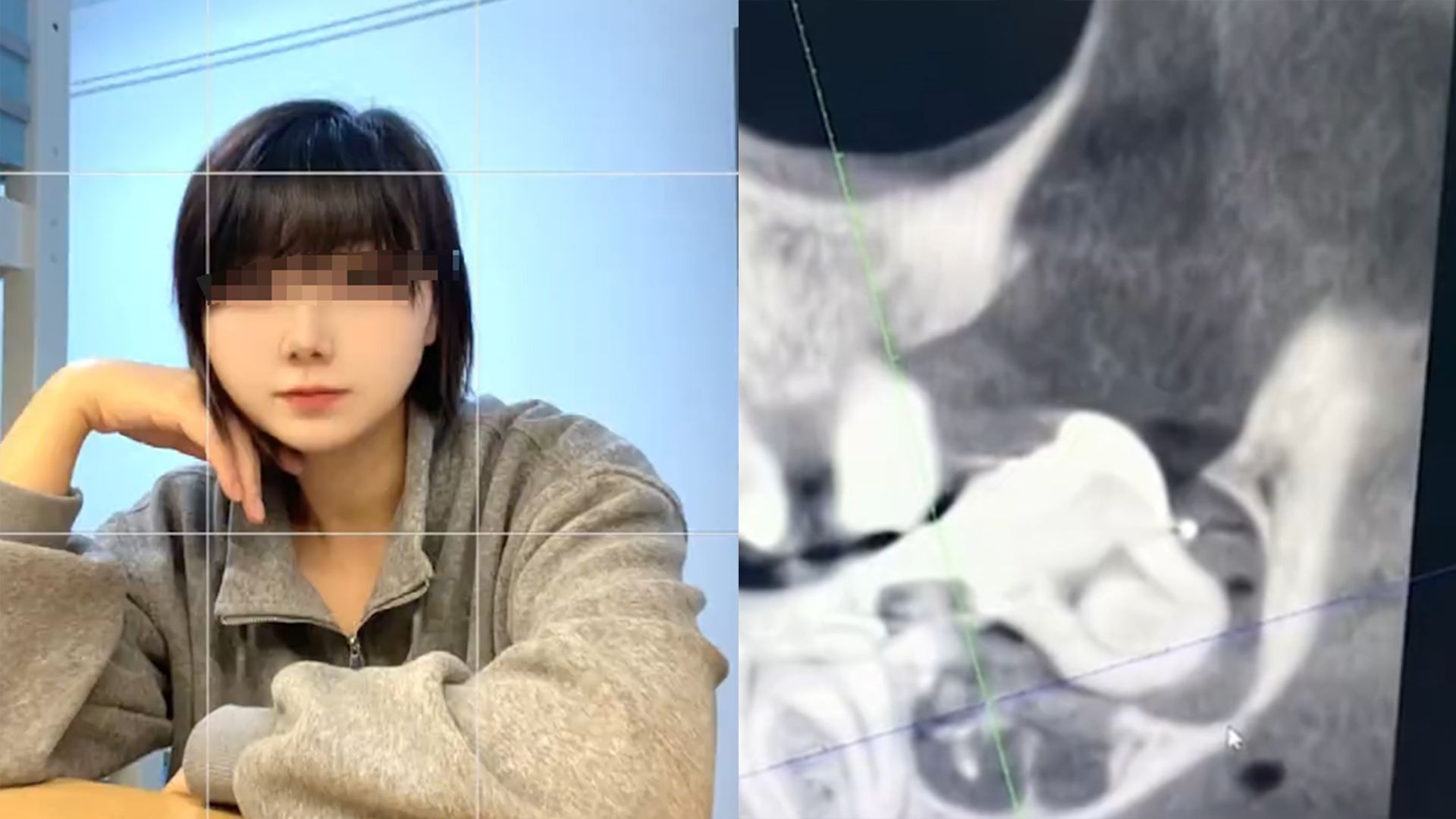 34岁女子疑因“拔错智齿又被塞回”坠楼身亡，家属：硬生生拔下来