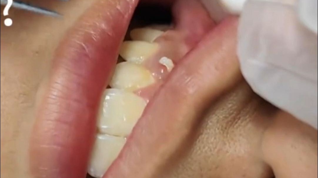 牙龈上长牙，拔出瞬间看着就痛