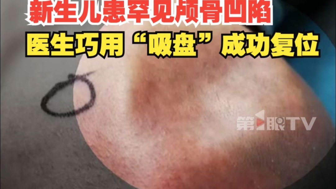 新生儿患罕见颅骨凹陷，头顶右侧有明显凹坑，医生巧用“吸盘”成