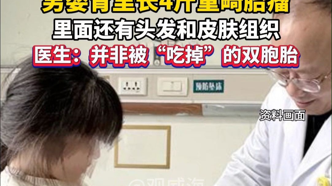 4个月大男婴胃里长4斤重畸胎瘤，里面还有头发和皮肤组织。