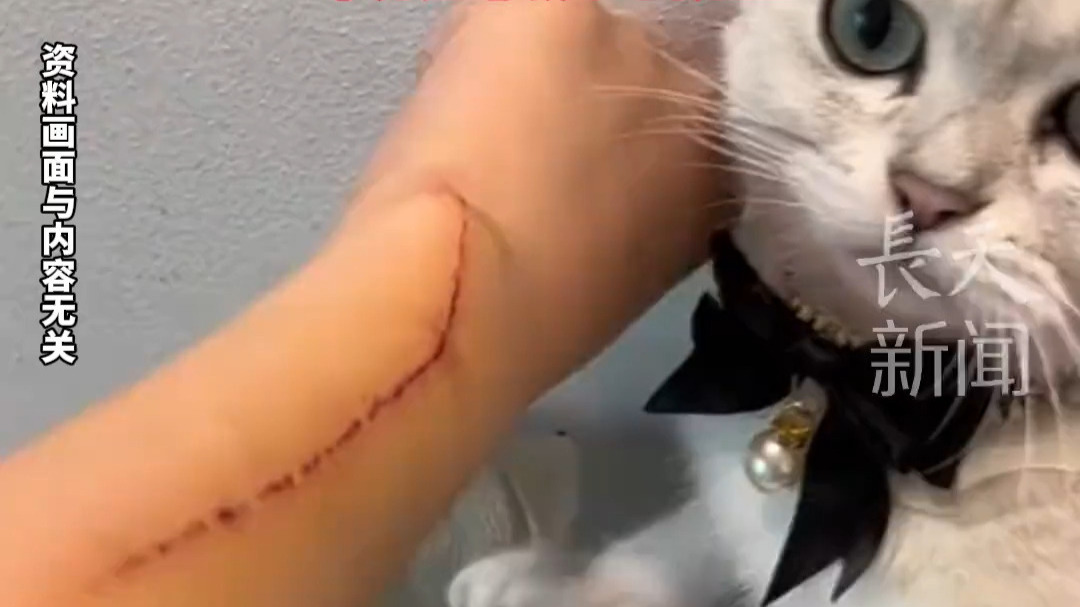 女孩手背被猫抓伤，感染“猫抓病”，当时没出血，没在意，后来发烧39
