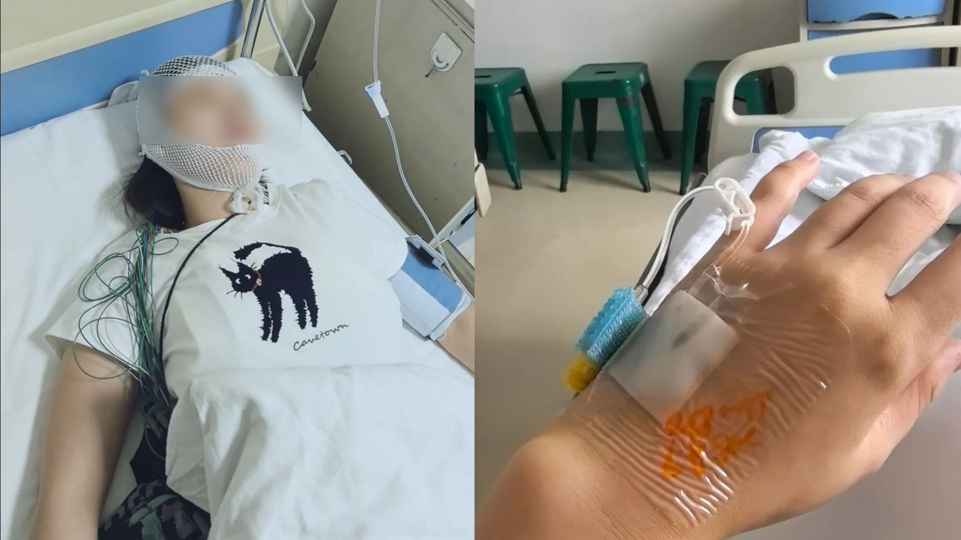 女子淋雨后未及时处理，突发抽搐口吐白沫被送医，确诊病毒性脑膜