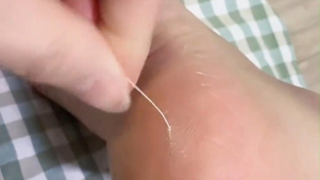 女子脚后跟突然针扎似的疼，结果竟是猫胡须扎进去了