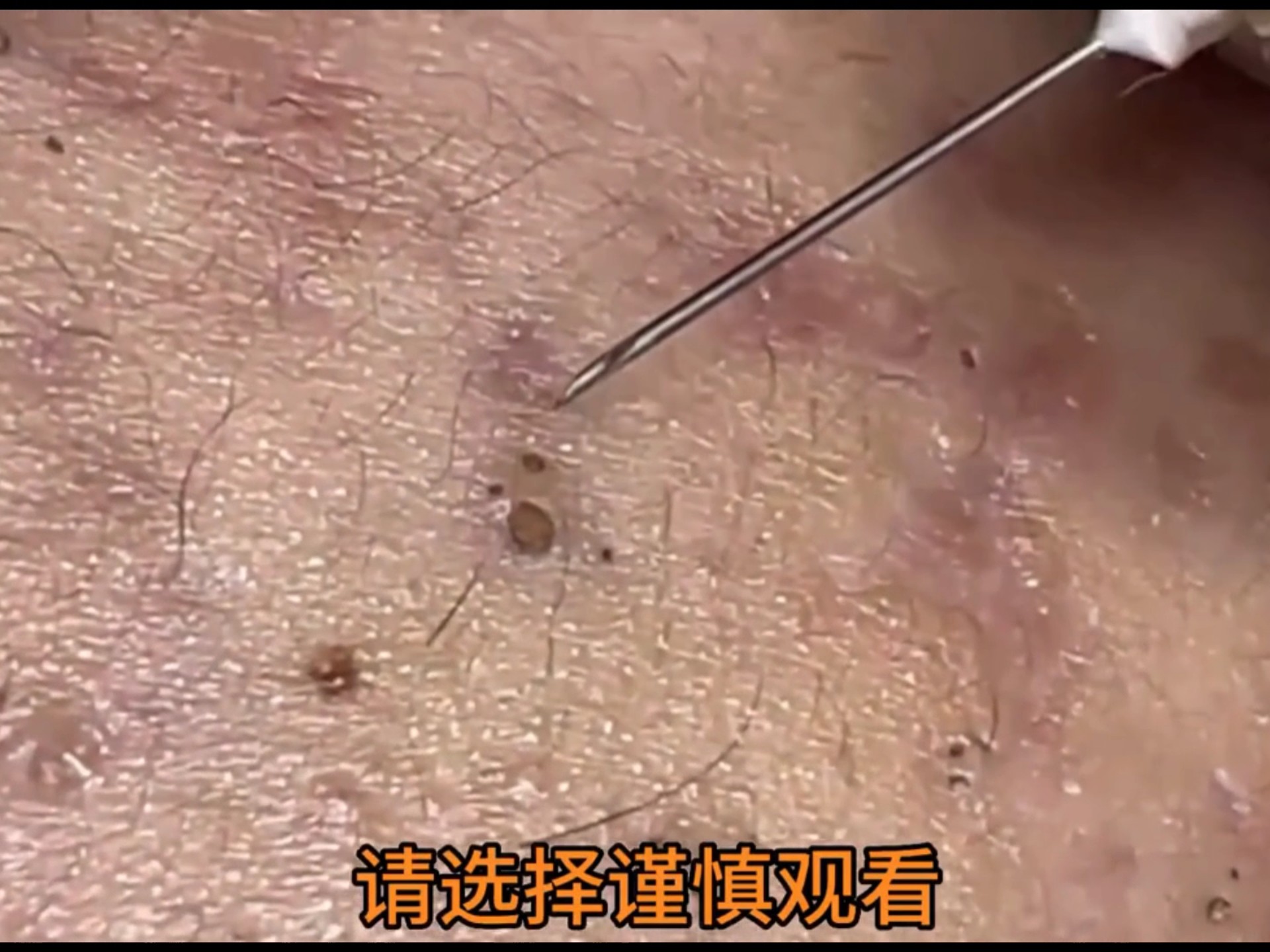 去黑头很解压，没想到这么好用哇！！！