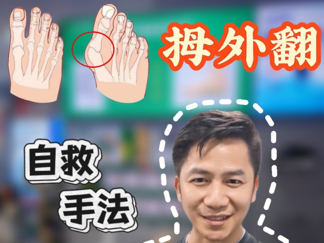 拇外翻自救指南