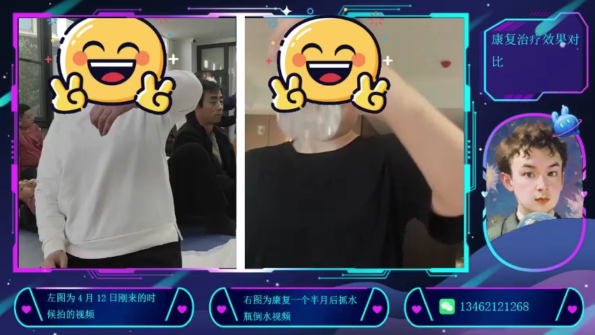 康复治疗训练之效果对比走路时抓握水瓶不掉而且还能上下移动